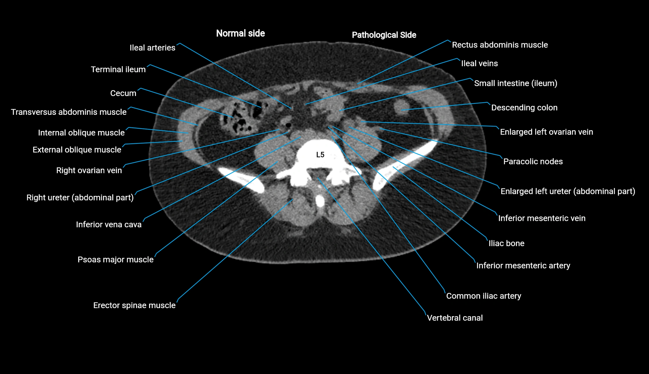 CT KUB axial cross sectional anatomy  radiology image -img-00201-00098.webp